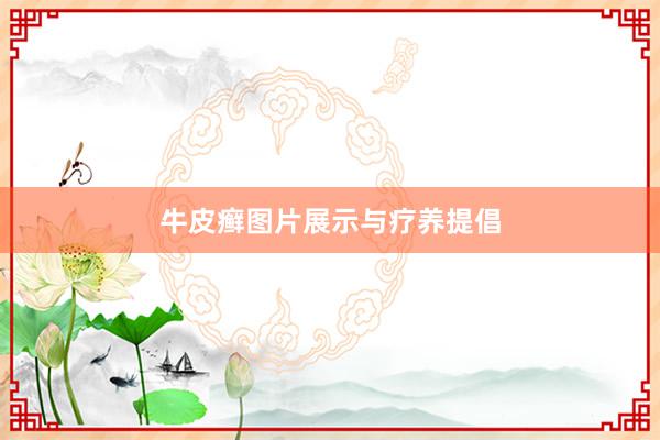 牛皮癣图片展示与疗养提倡